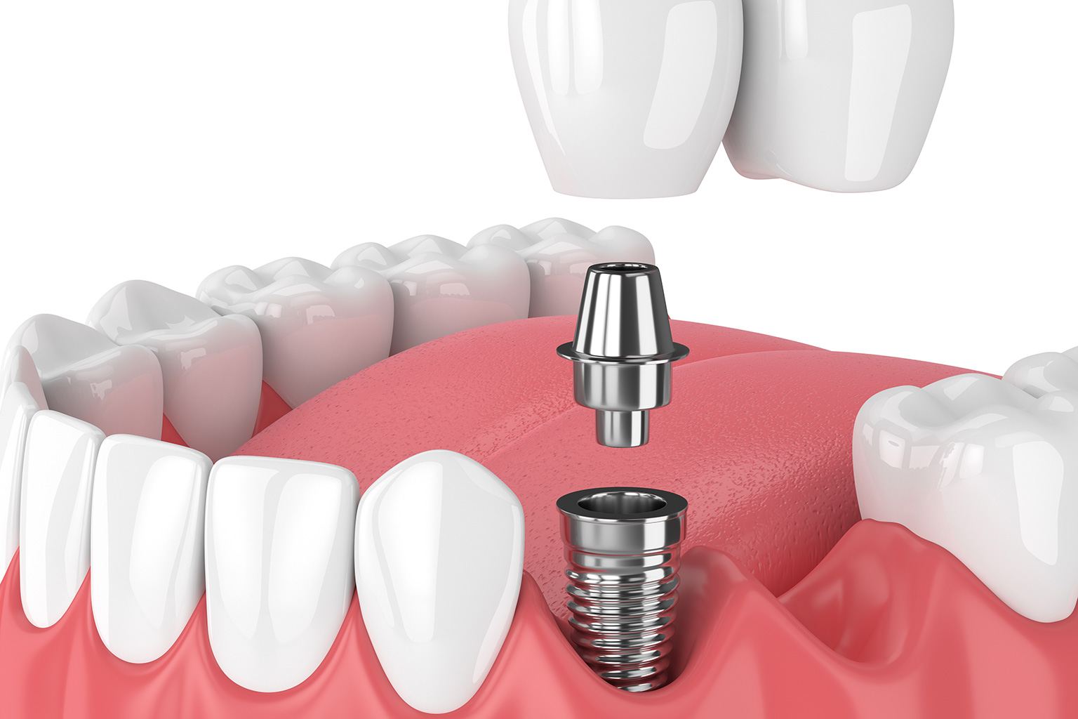 dental implant in st marys