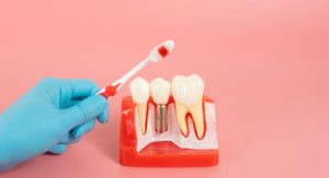 cost of dental implants in australia illustration