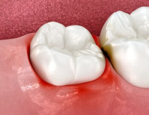 wisdom tooth pain infected wisdom tooth pain infected