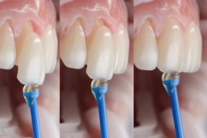 Are Porcelain Veneers Permanent application Are Porcelain Veneers Permanent application