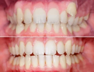before and after effects of orthodontic procedure before and after effects of orthodontic procedure