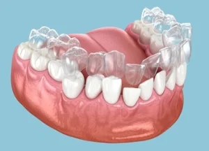 model of mouth being corrected using invisalign model of mouth being corrected using invisalign