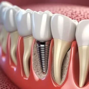 Single Tooth Implant Cost Australia image Single Tooth Implant Cost Australia image