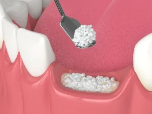 dental bone graft procedure dental bone graft procedure