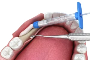 dental bone graft treatment dental bone graft treatment